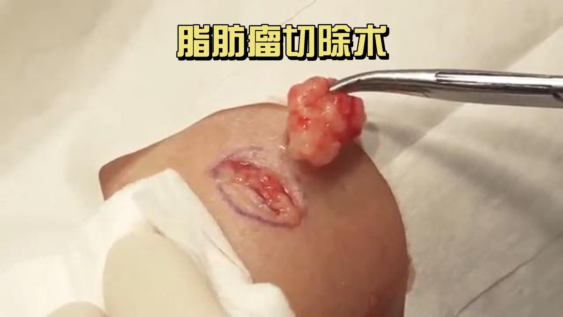 脂肪瘤切除术（非医学相关专业慎入）