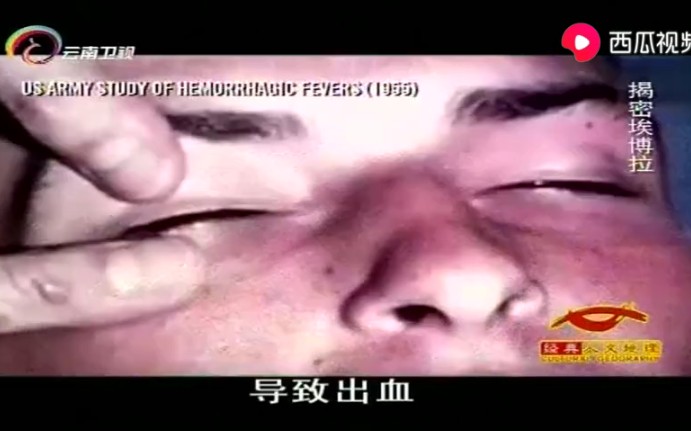 埃博拉病毒!它的症状,竟相当于艾滋病加败血症!哔哩哔哩bilibili