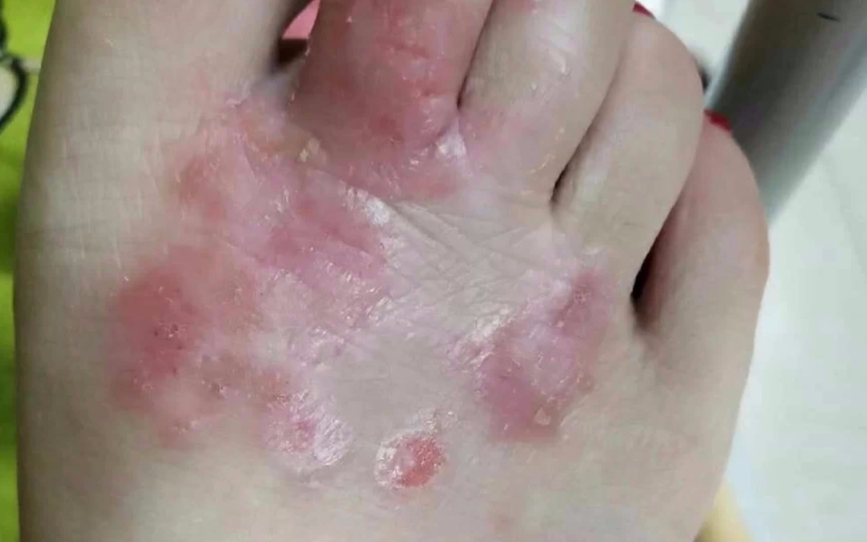 脚上脱皮糜烂不用怕!还好我有这个小绝招!