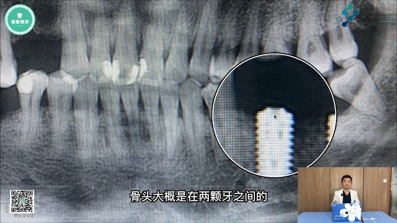 10第二章 种植手术基础【第三节课】.认识平台转移、龈水平、骨水平、莫氏锥度、内六角连接等基本概念哔哩哔哩bilibili