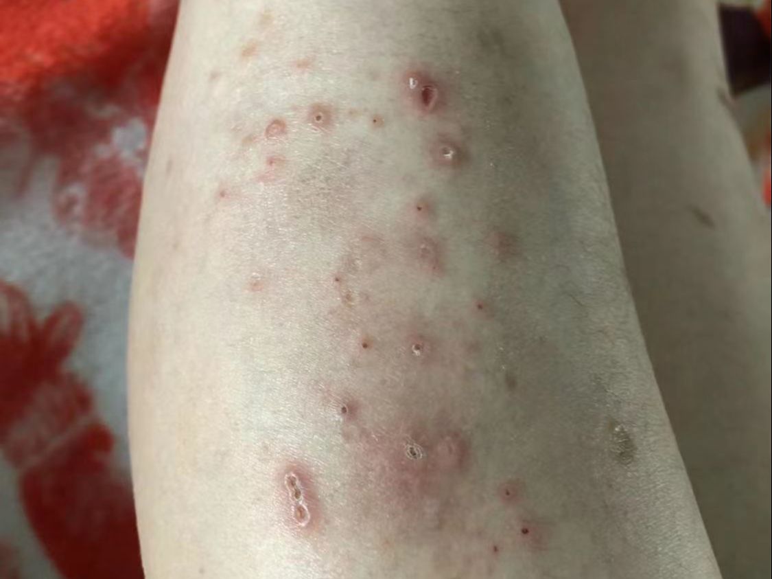 记录了半年才明白,要根除湿疹这4点坚决不能做,方法一定要对!