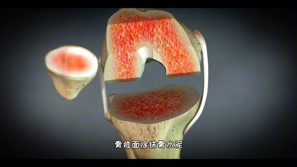 原装的才是最好的,膝关节人工关节置换手术,3D演示..哔哩哔哩bilibili