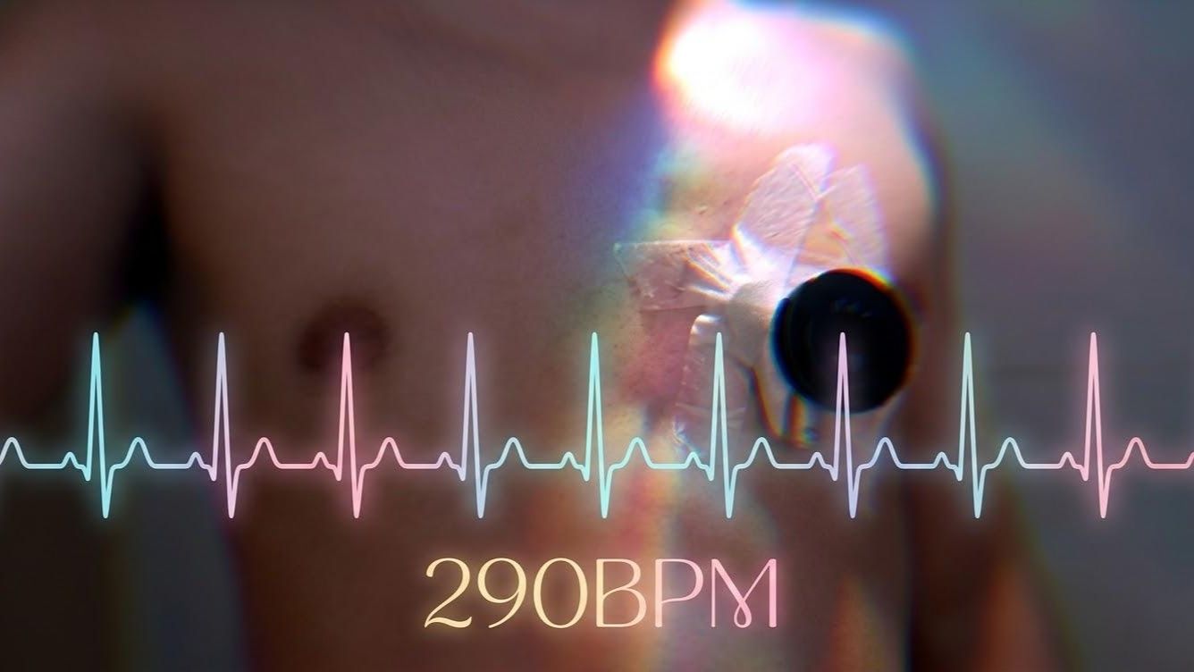 运动后突发心律失常 心率高达280 心跳声