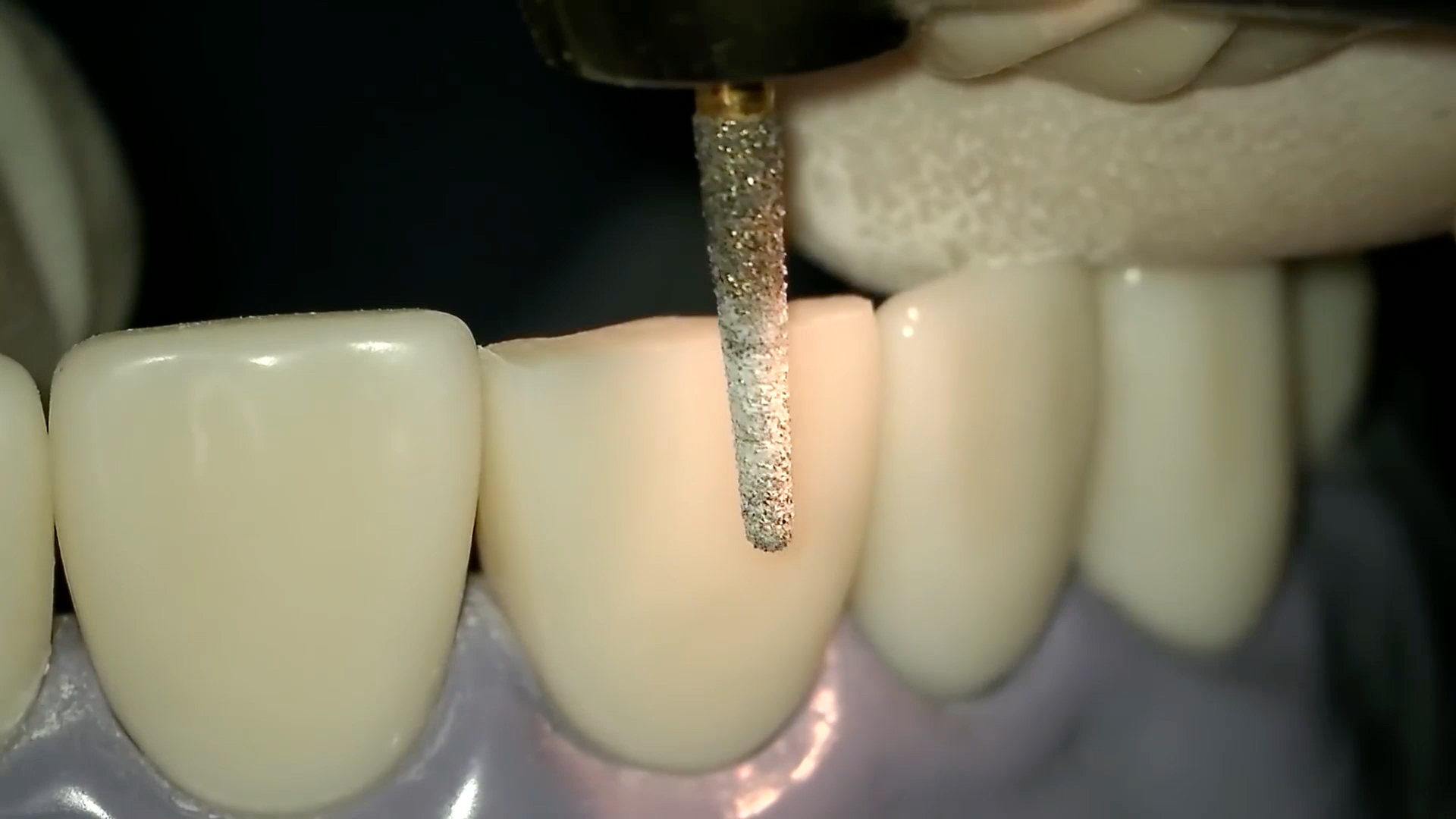 活动作品想要给牙齿戴冠那就要先做这个准备