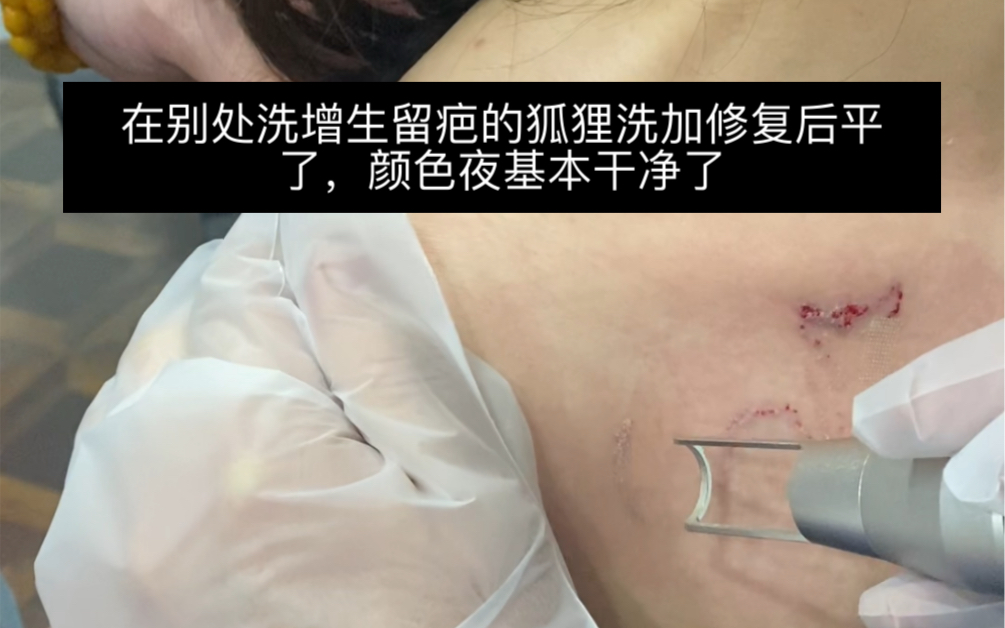 洗纹身增生留疤了怎么办,可以接着洗加修复,苏州常州无锡南京镇江扬州洗纹身洗眉祛疤哔哩哔哩bilibili