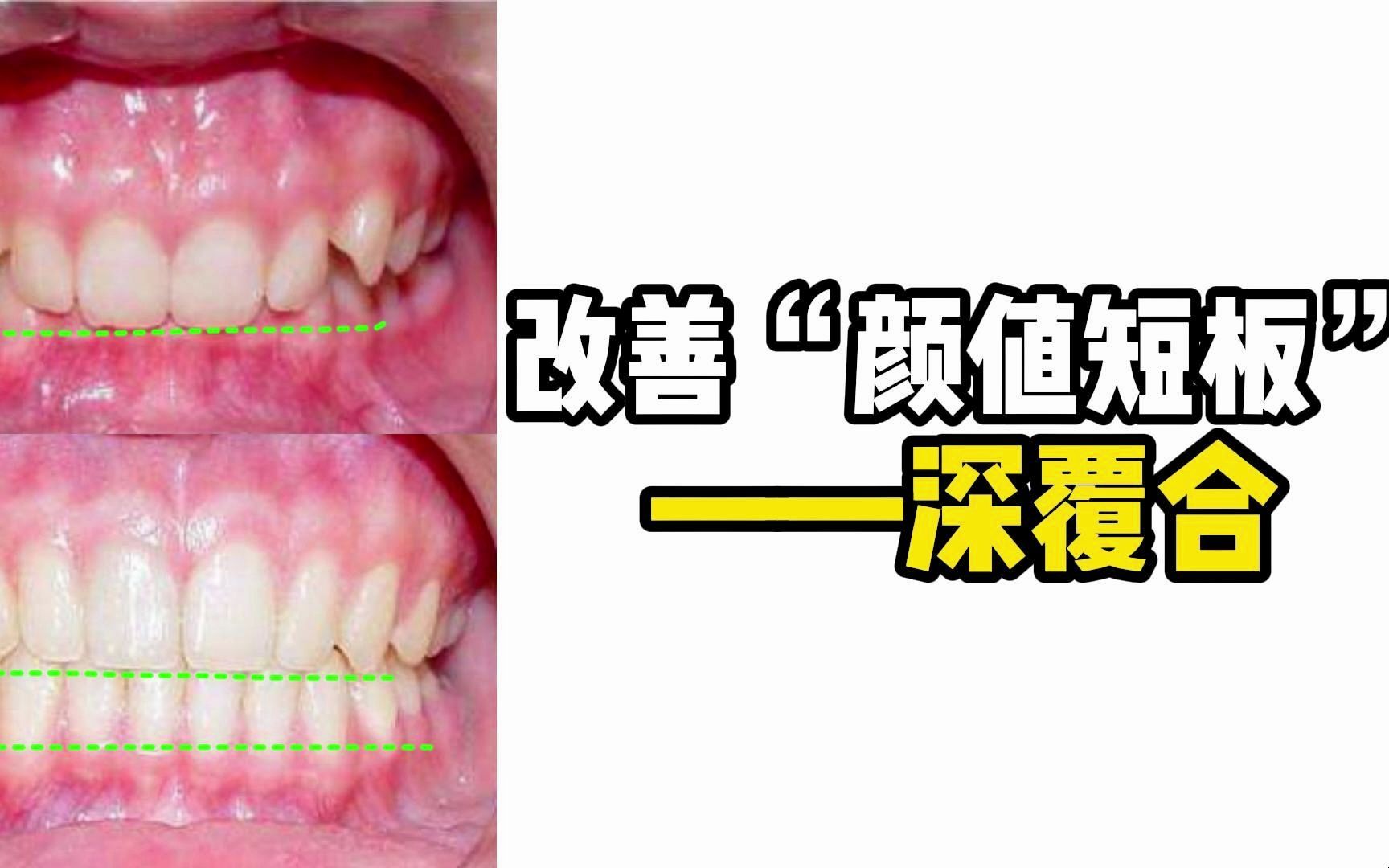 [图]改善“颜值短板”——深覆合