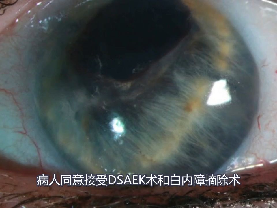 DSAEK处理虹膜角膜内皮综合征哔哩哔哩bilibili