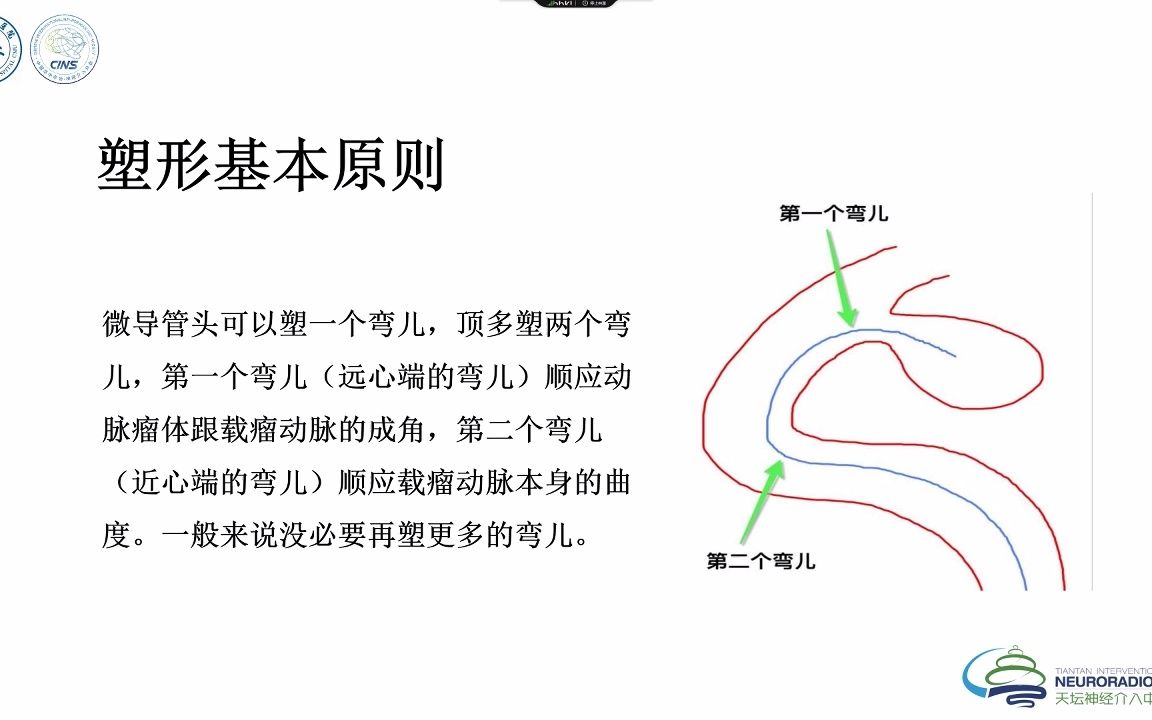 颅内动脉瘤栓塞术中微导管塑形  精选视频哔哩哔哩bilibili