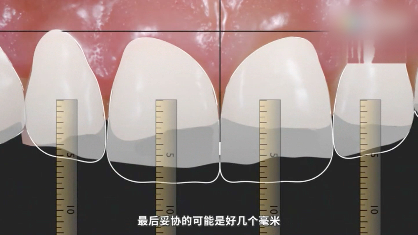 牙齿美学修复哔哩哔哩bilibili