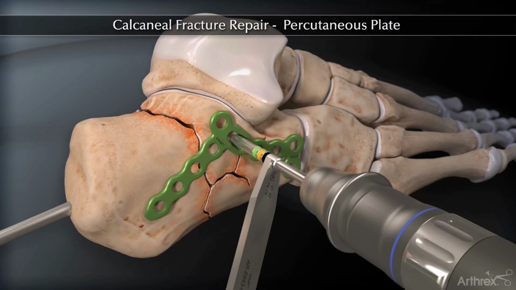 足跟跟骨骨折的手术修复过程,3D演示..哔哩哔哩bilibili