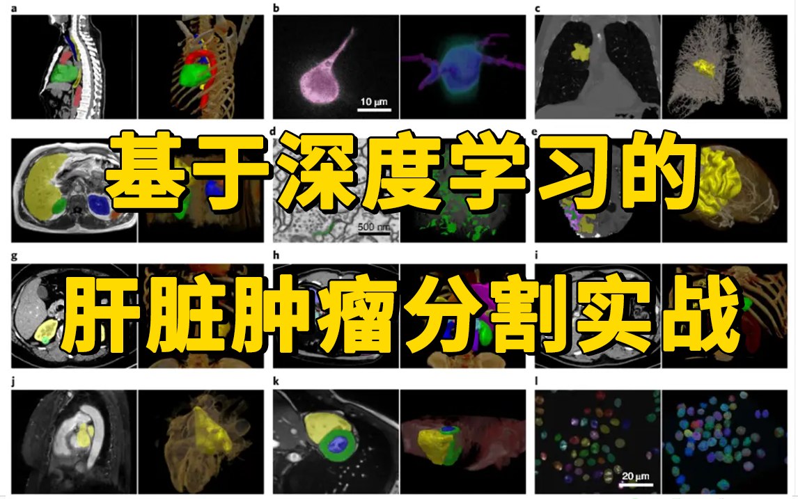 AI医学图像分割必会实战:基于深度学习的肝脏肿瘤分割实战,原理详解+项目实战,究极通俗易懂!哔哩哔哩bilibili