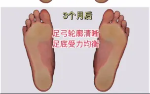 Download Video: 13岁女生扁平外翻足穿戴定制足垫3个月第一次复查，改善明显，期待下一阶段的复查