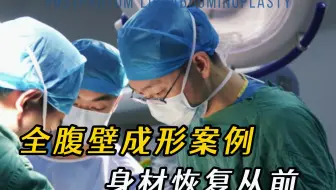 全腹壁成形案例