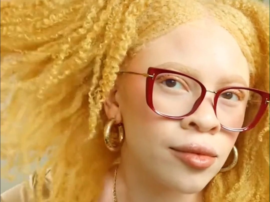 患有白化病的黑人小姐姐,长着满头金色的自然卷发