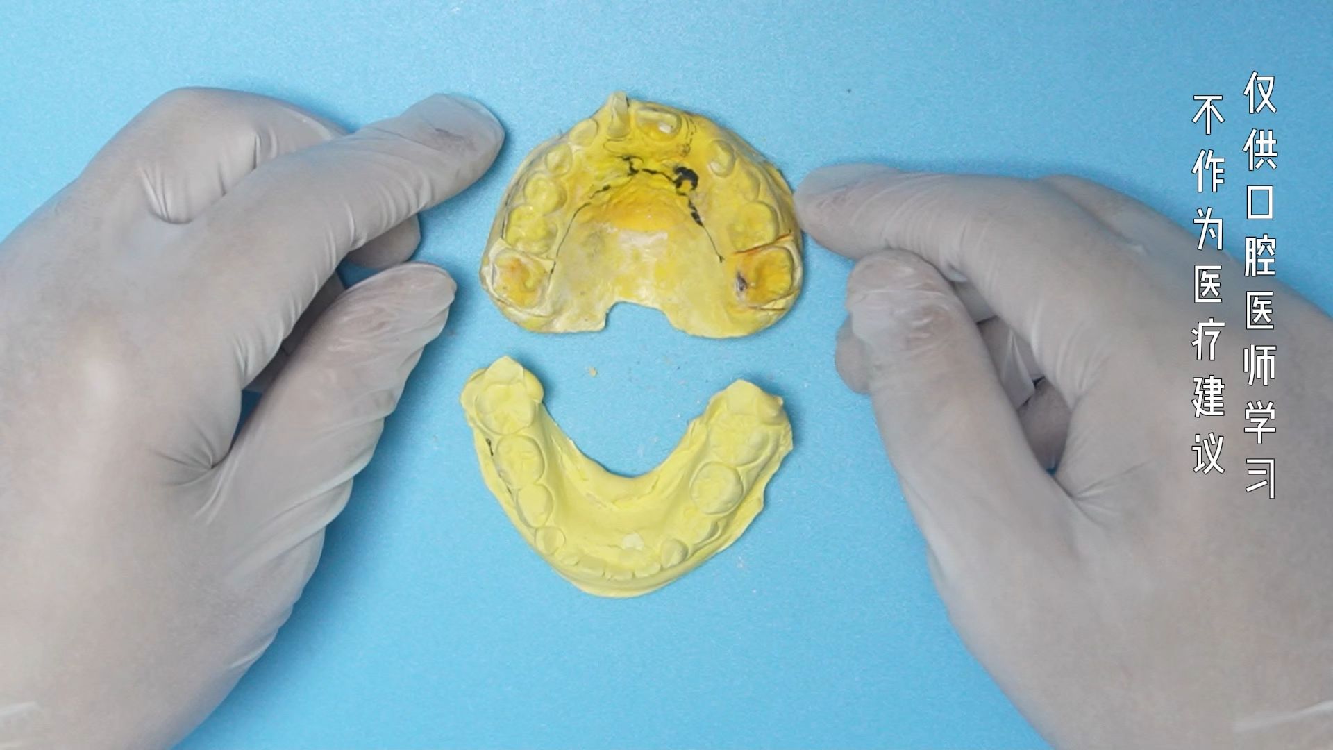 带牵引钩的nance托 妃她正畸 儿童牙齿矫正