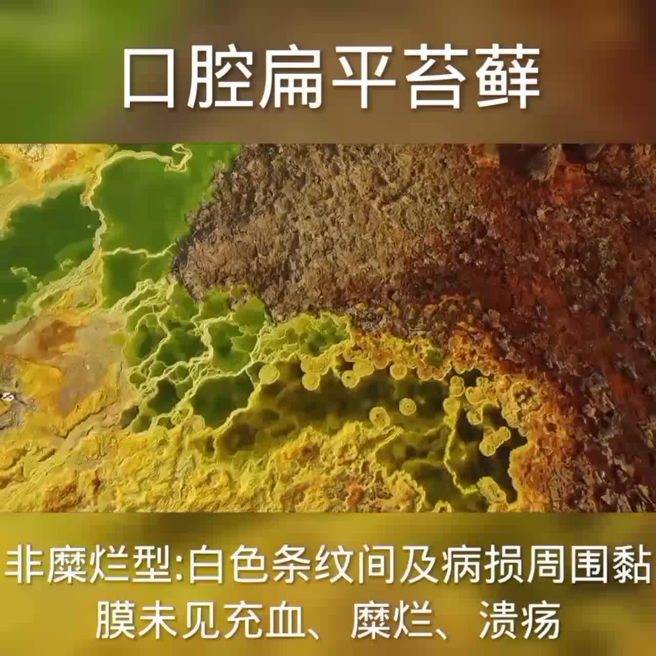 口腔扁平苔藓【视频二】