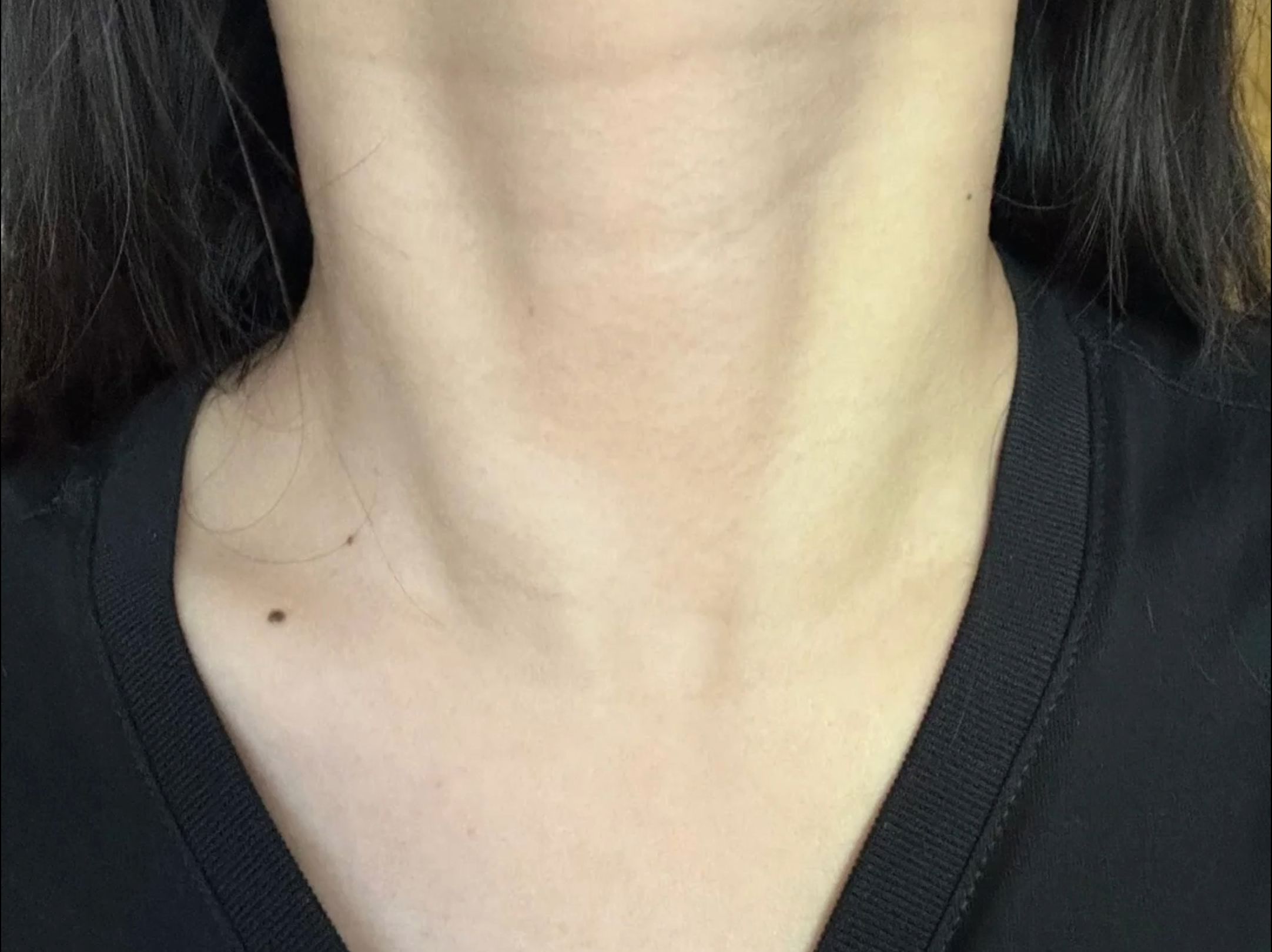 今日案例分享——"天鹅颈"