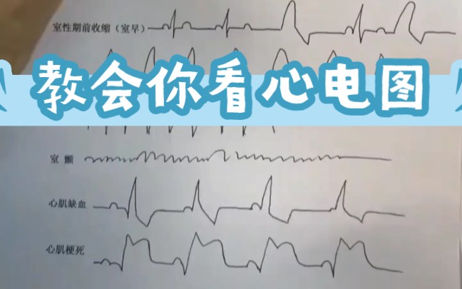 [图]零基础看懂心电图