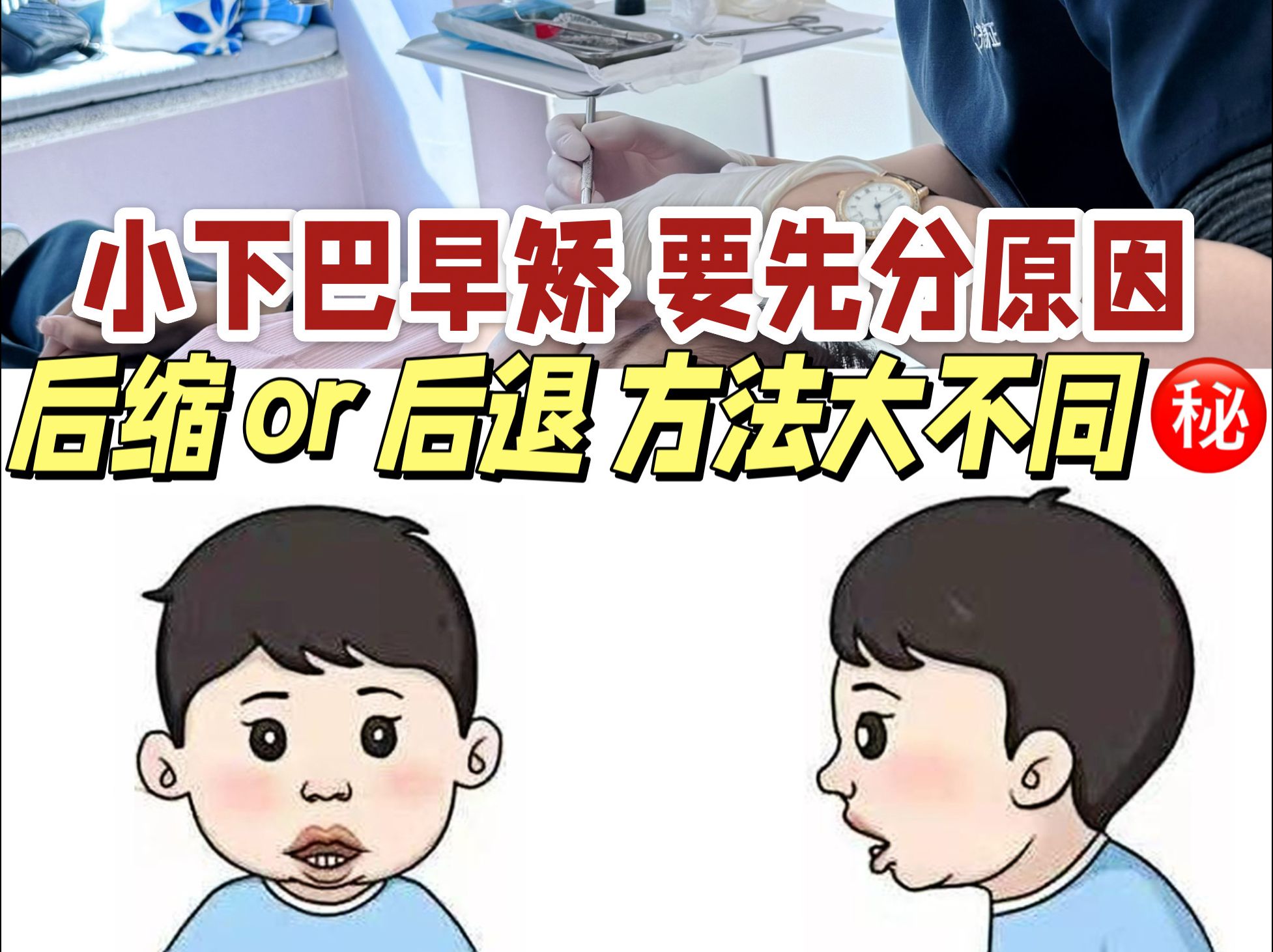 下巴后缩&下巴后退,分别对应不同的矫正解题思路