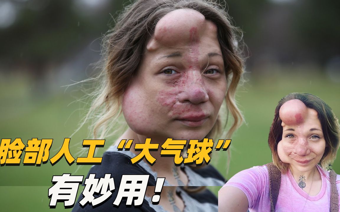 脸上养"气球",为整形手术做准备.罕见病患者的蜕变.