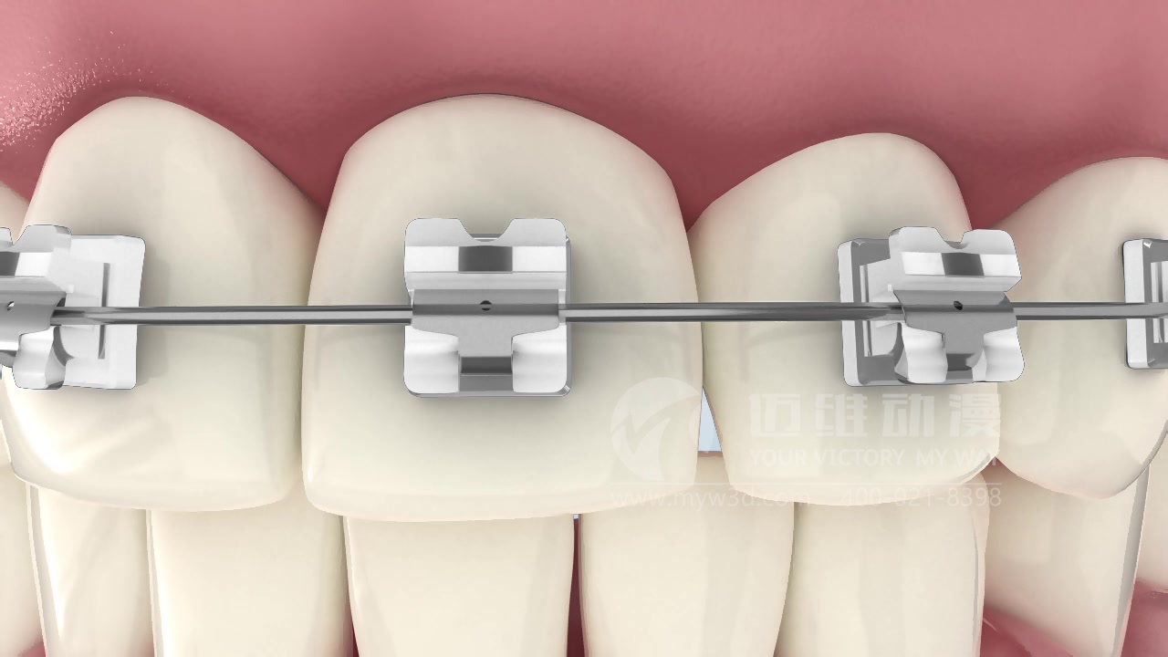 自锁托牙齿矫正牙套三维动画医疗器械三维动画三维动画制作哔哩哔哩bilibili