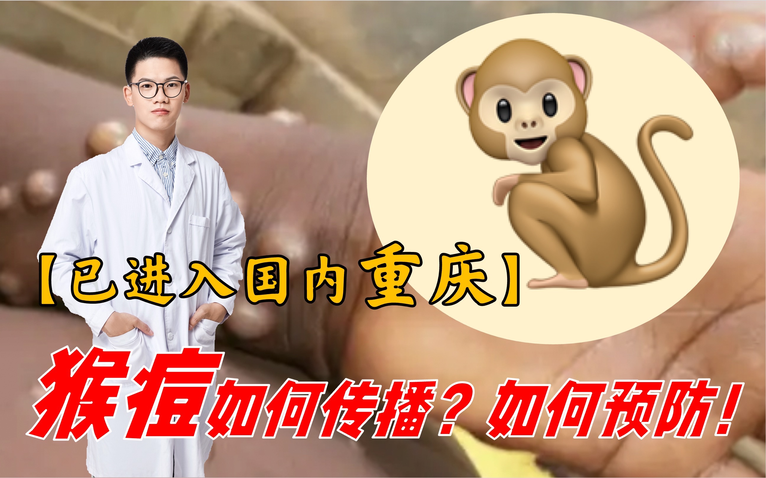 [图]猴痘输入重庆！如何传播和预防？六分钟带你了解猴痘的七大真相！