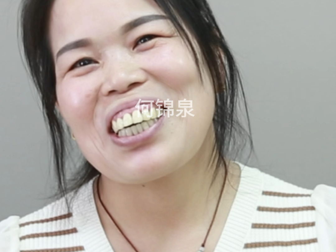 50岁大姐凸嘴龅牙,正颌改善后也太美了!