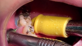 虫牙蛀牙是怎么形成的 龋齿预防 哔哩哔哩 つロ干杯 Bilibili