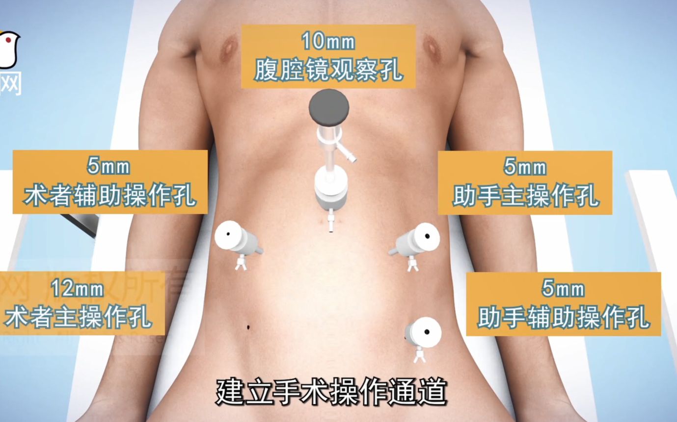 3d医学动画:微创腹腔镜手术 ⷧ›𔨂 癌切除手术哔哩哔哩bilibili