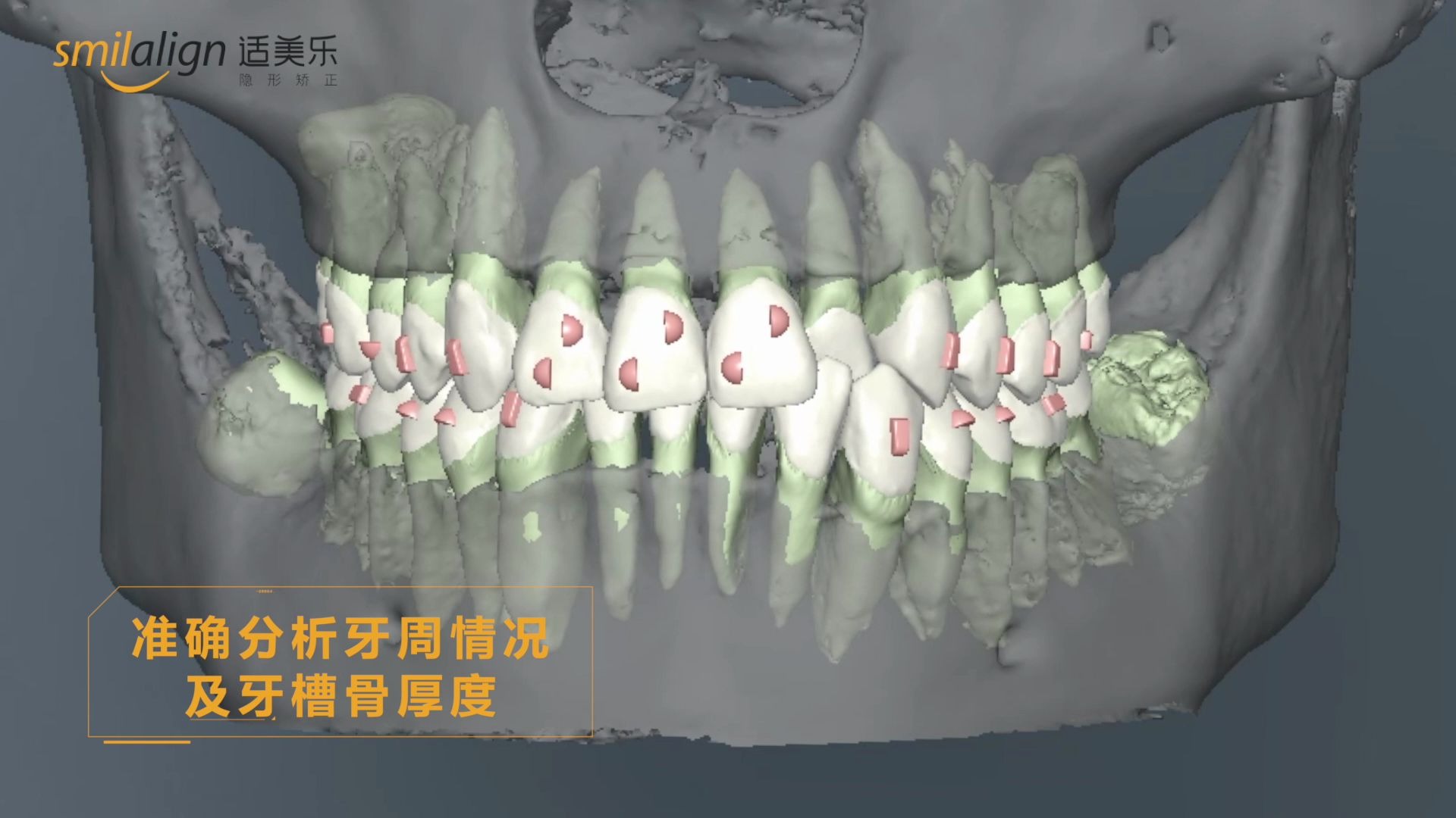 适美乐隐形矫正3D根骨分析技术,监控牙根位置哔哩哔哩bilibili