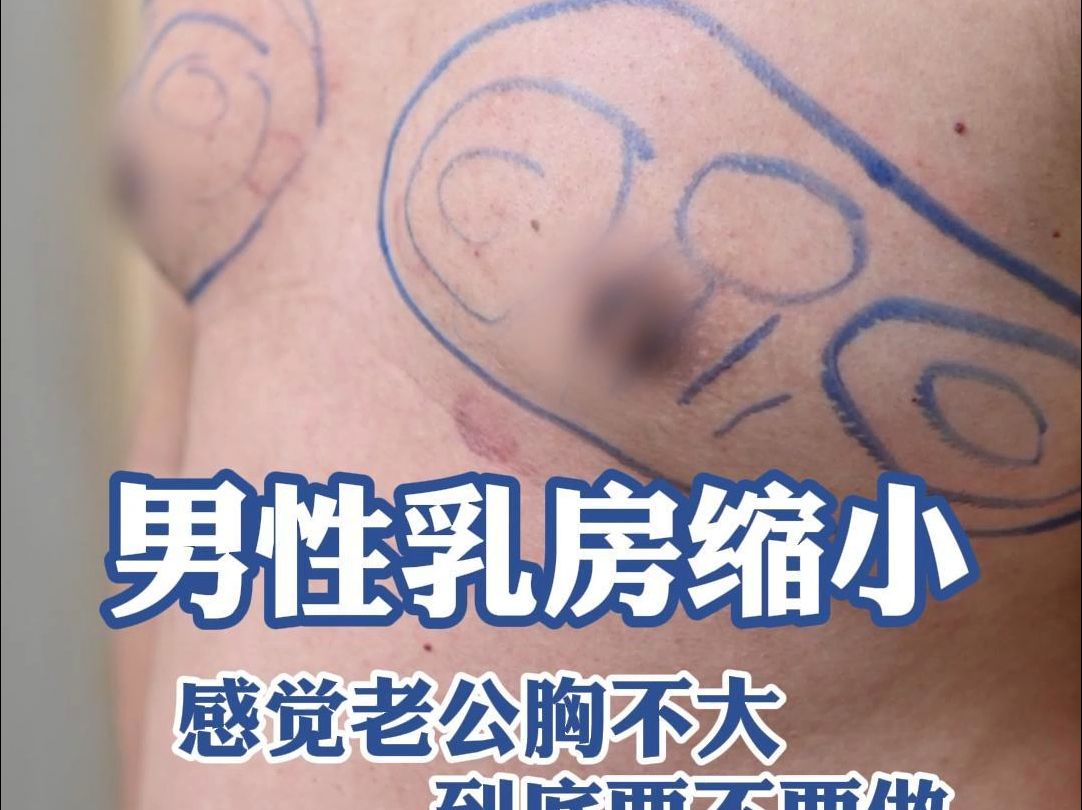 男性乳房缩小术:感觉老公的胸不大,到底要不要做?