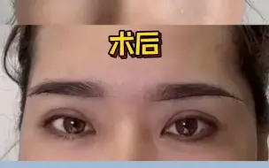 Download Video: 45岁眼皮耷拉三角眼，还能做双眼皮吗？