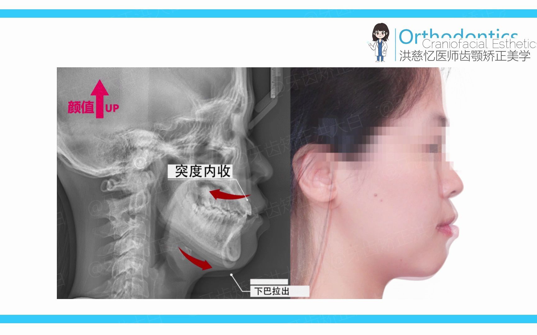 矫正可以改变脸型案例分享哔哩哔哩bilibili