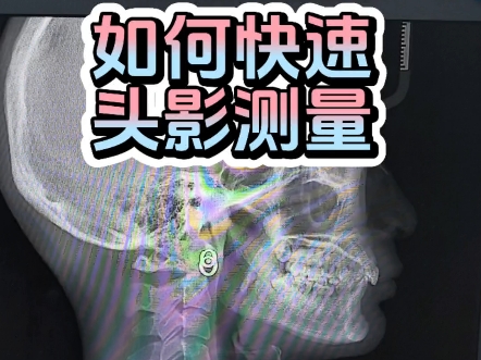 人人都能学会的头影测量 77.