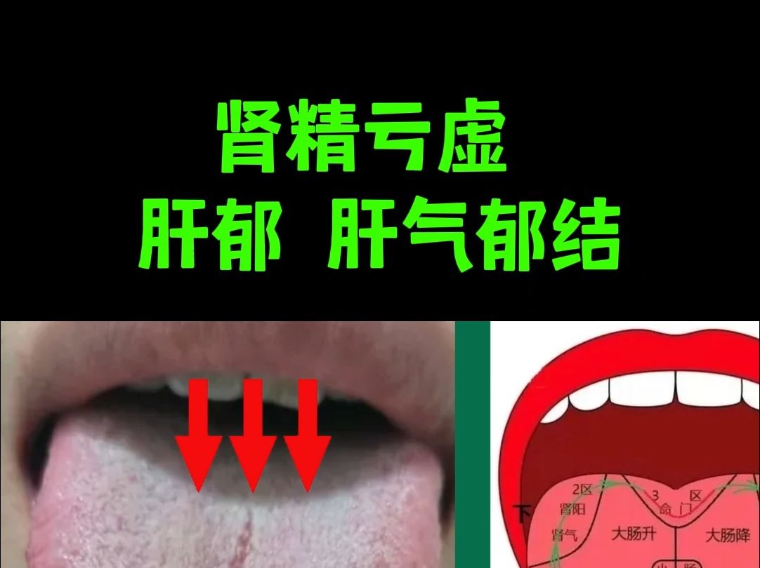 舌诊分析:这种舌象明显的是,肾精亏虚 肝郁 肝气郁结哔哩哔哩bilibili