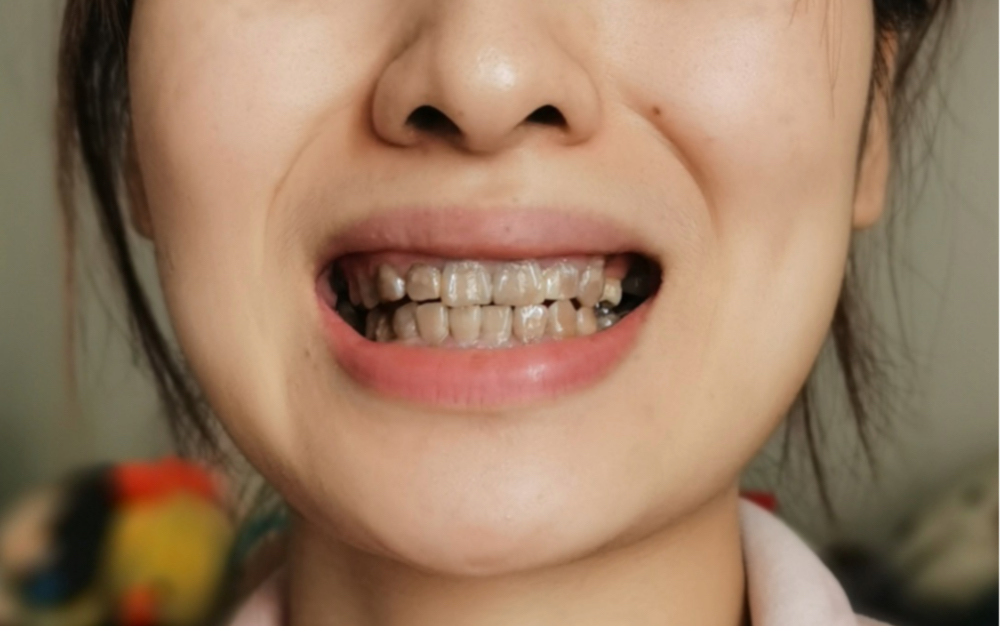 一个"黑牙女孩"自卑的20年如何改变自己