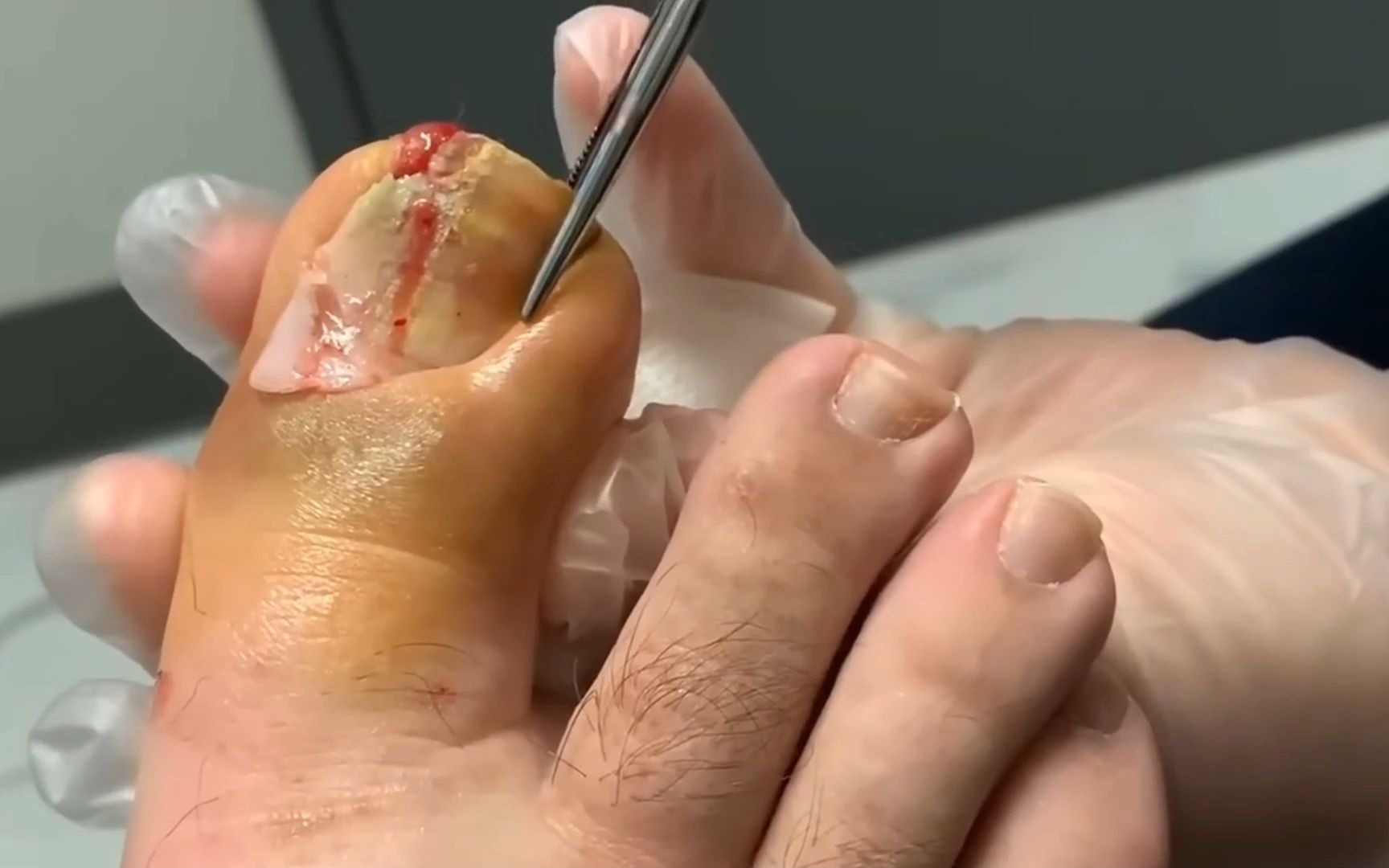 【甲沟炎】一次性拔掉两个指甲