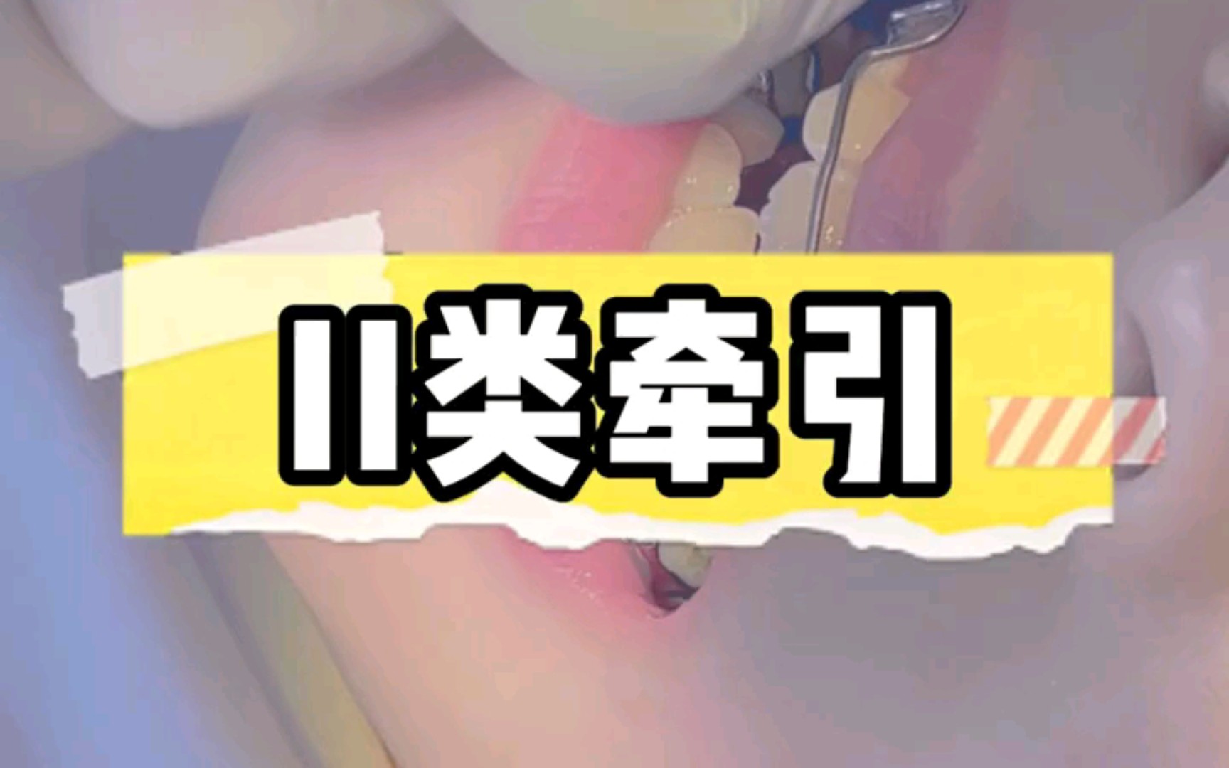 二类牵引哔哩哔哩bilibili