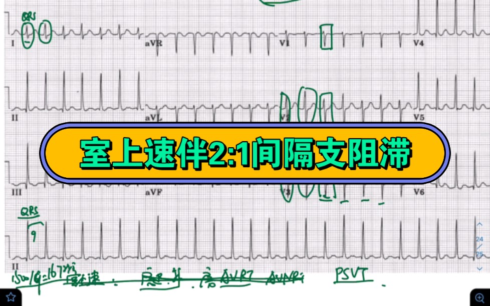 室上速伴2:1间隔支阻滞哔哩哔哩bilibili