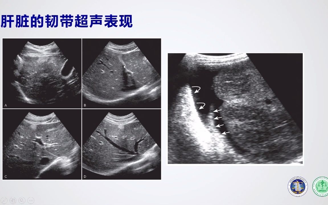 [图]肝脏常见疾病的超声诊断