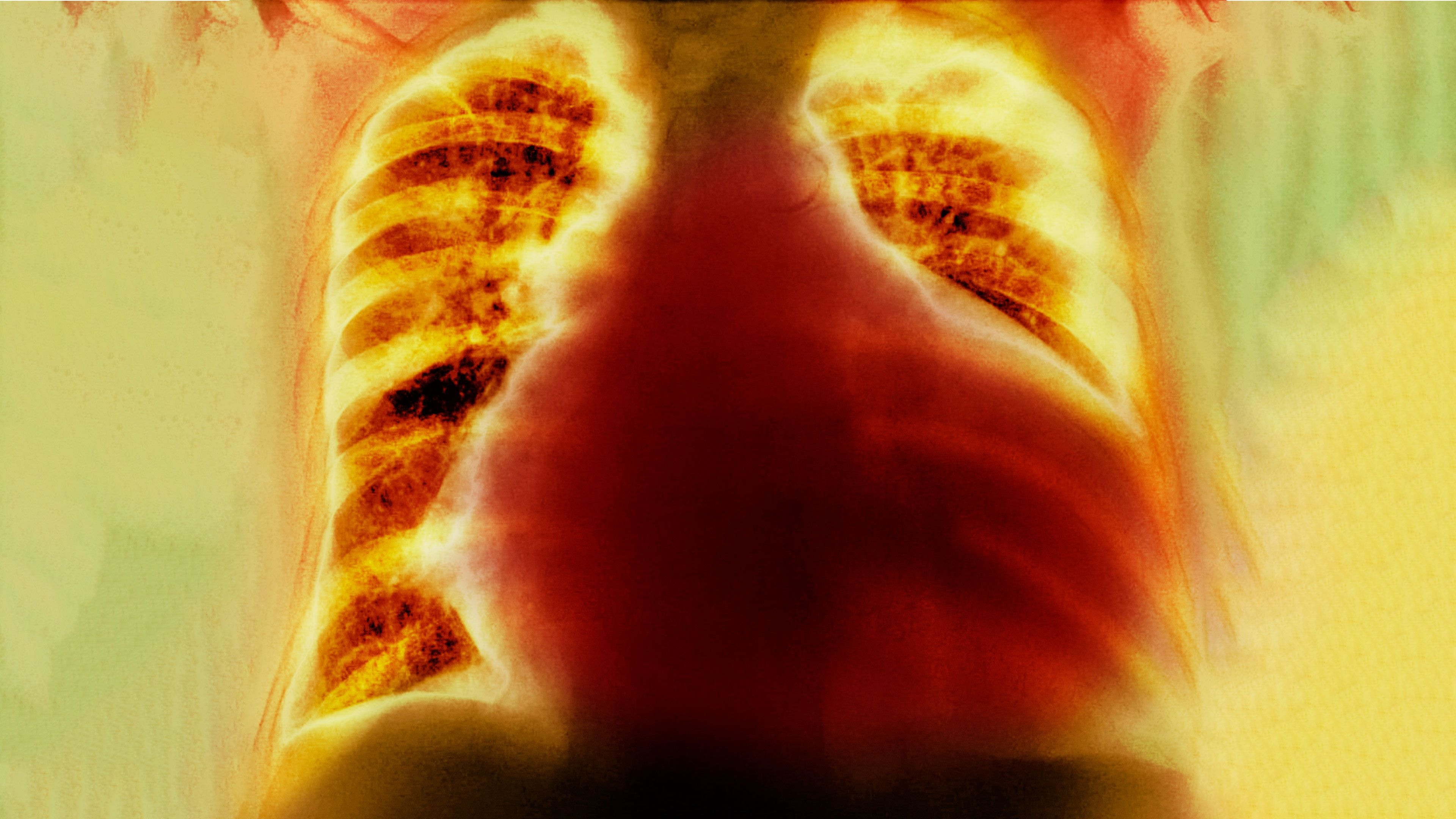 一位健美运动员在备赛时滥用了利尿剂，这是他的心脏发生的变化