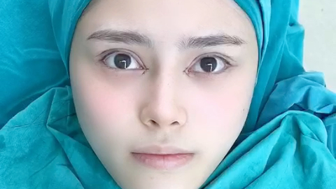 双眼皮修复术后即刻,宽改窄,修复肉条感