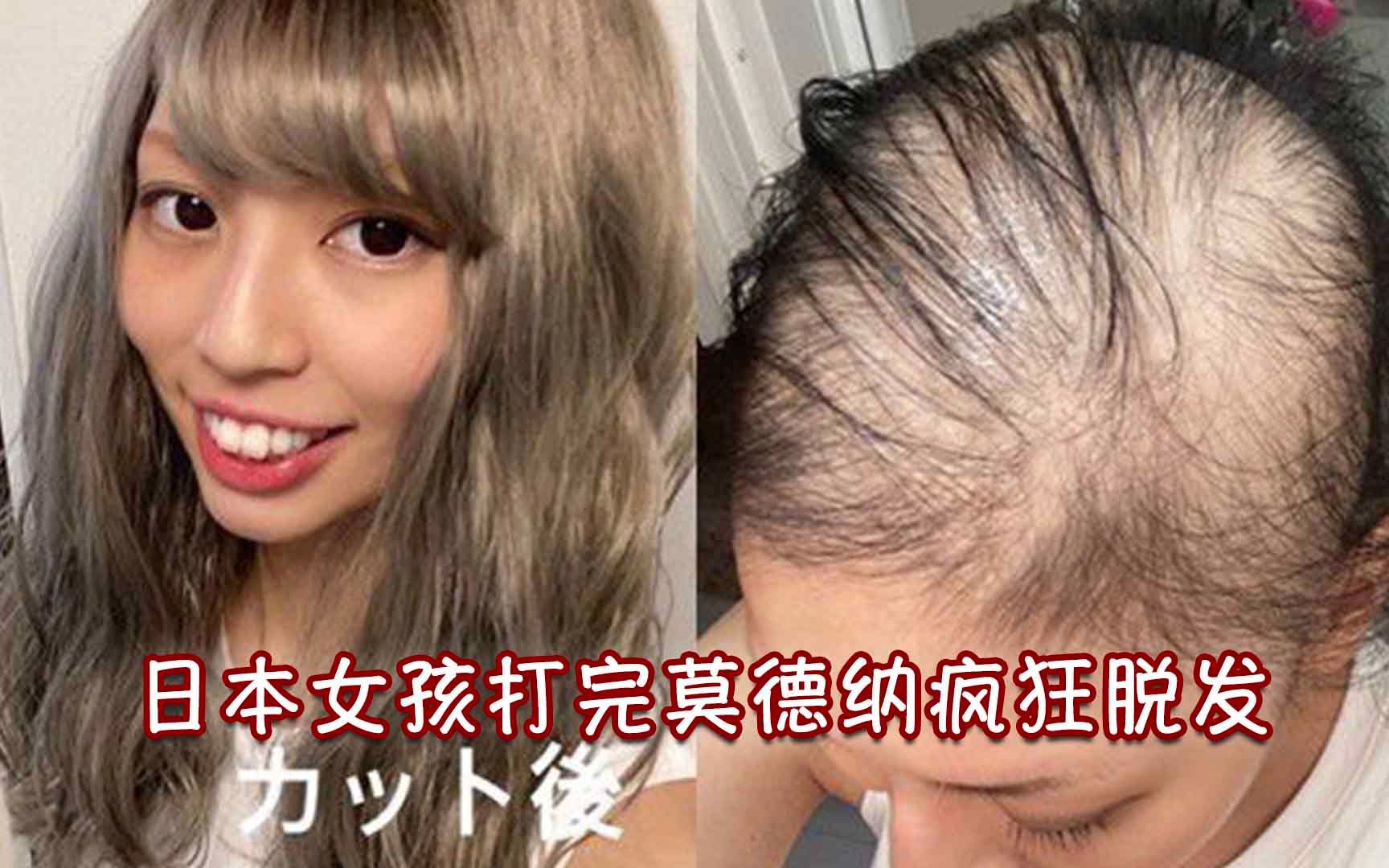 [图]打完莫德纳疯狂脱发！日本女子亲曝全过程 1个月后几乎成光头