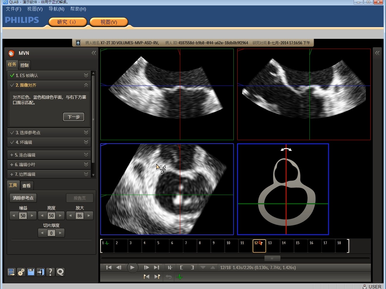 飞利浦qlab10_mvn_二尖瓣量化分析插件 讲解03-任务一至四-mpr调节-02