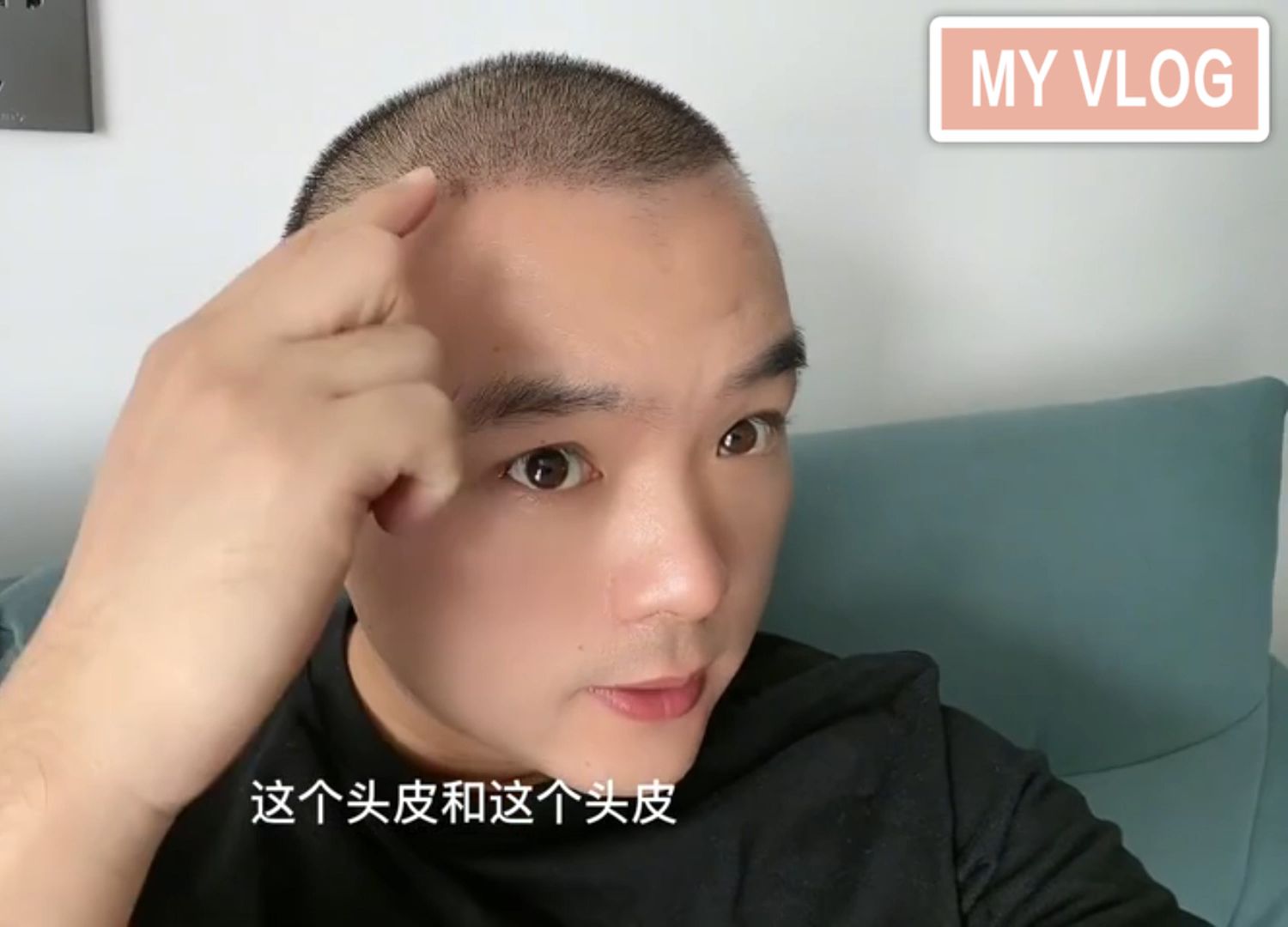 植发后几天可以摸植发区(植发后几天可以摸植发区的东西)