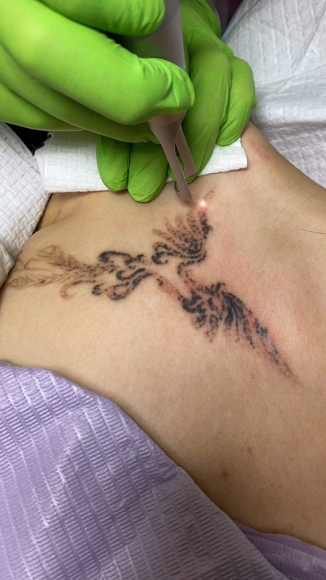 皮秒洗纹身第二次操作中.