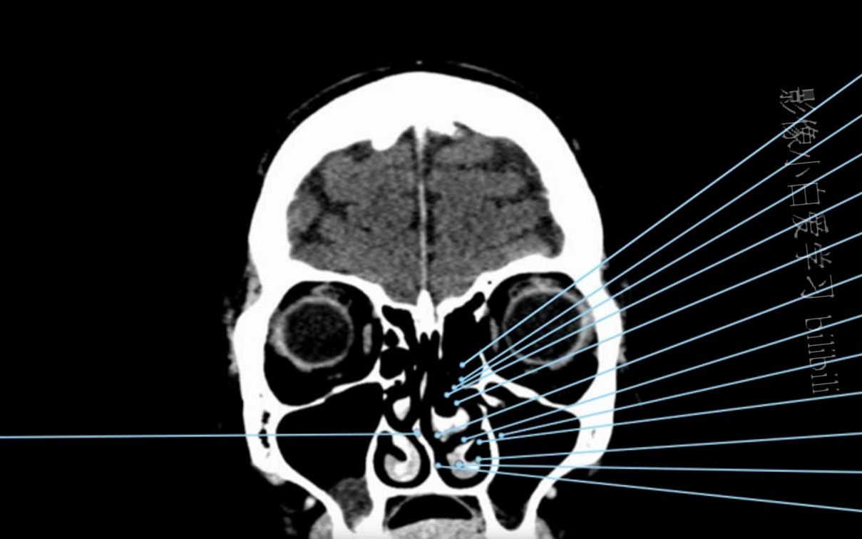 3.颅脑CT解剖图谱鼻窦CT解剖哔哩哔哩bilibili