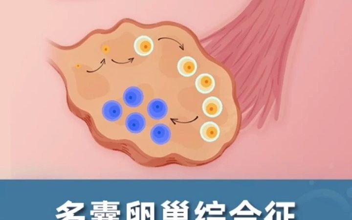 多囊卵巢综合征到底是个什么鬼?哔哩哔哩bilibili