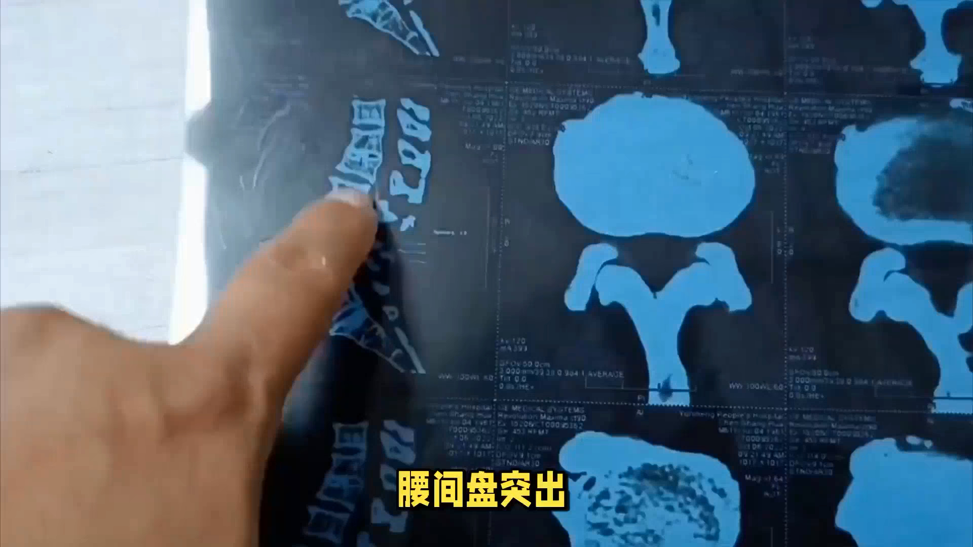 老腰突就用铁腰板治疗仪