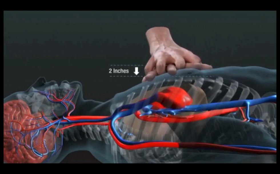 心肺复苏之心脏按压原理动画演示哔哩哔哩bilibili